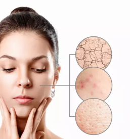 Oxilver za glivice in za razdrazeno kozo