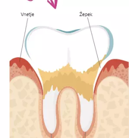 Nujna pomoc pri parodontozi slovenija