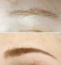 Nitkanje obraza maribor okolica