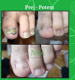 Kvalitetna pedikura Sevnica, Posavje