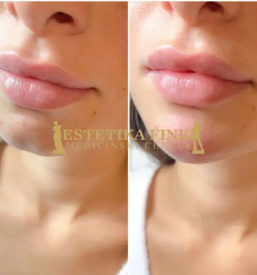 Polnila Ljubljana, Trzin