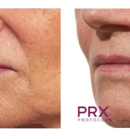 Uporaba botoksa za pomlajevanje Ljubljana