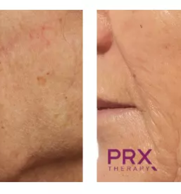 Učinkovito pomlajevanje z botoksom Ljubljana