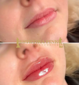 Hitro pomlajevanje z botoksom Ljubljana