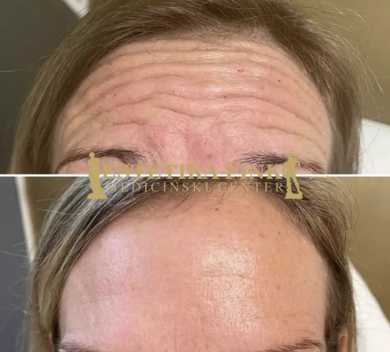 Pomlajevanje z botoksom Ljubljana, Trzin