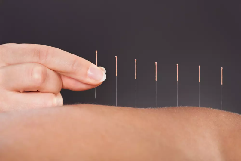 Medicinska akupunktura Obalno kraška