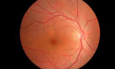 Operacija sive mrene Posavje