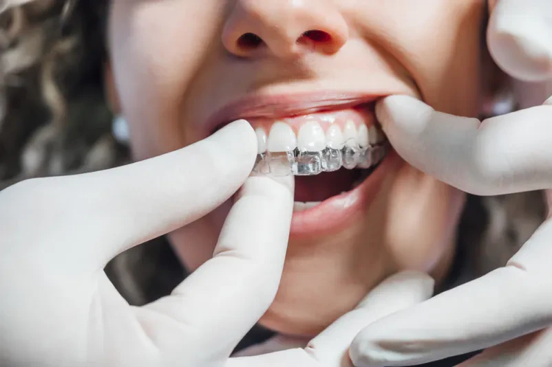 Zobni aparat Invisalign, Murska Sobota