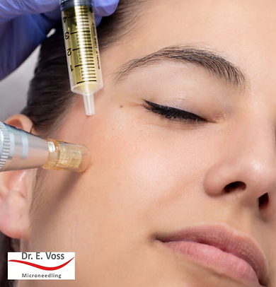 Microneedling Koroška