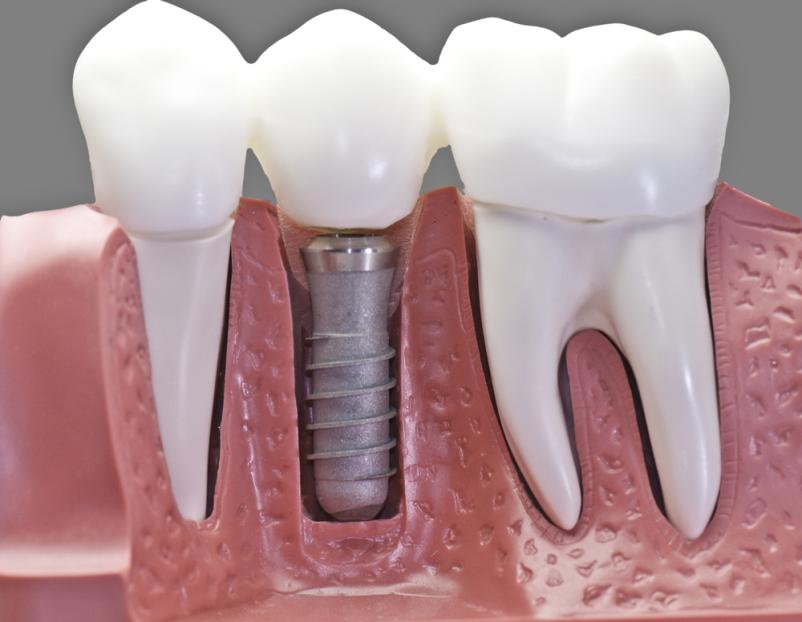 Dentalna implantologija Koper