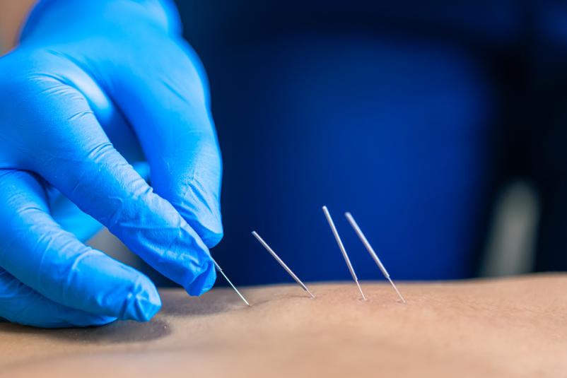  dry needling terapija 