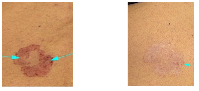 dermatološke spremembe