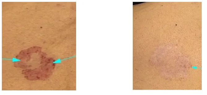 dermatološke spremembe
