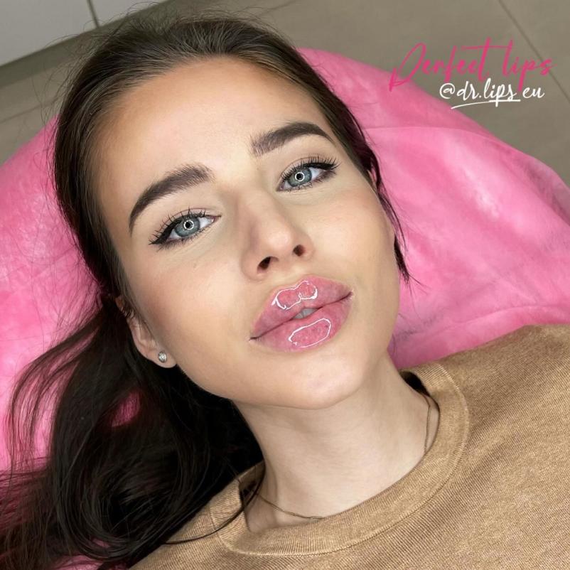 Polnjenje ustnic in kozmetične storitve