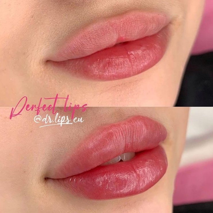 Povečanje ustnic Primorska