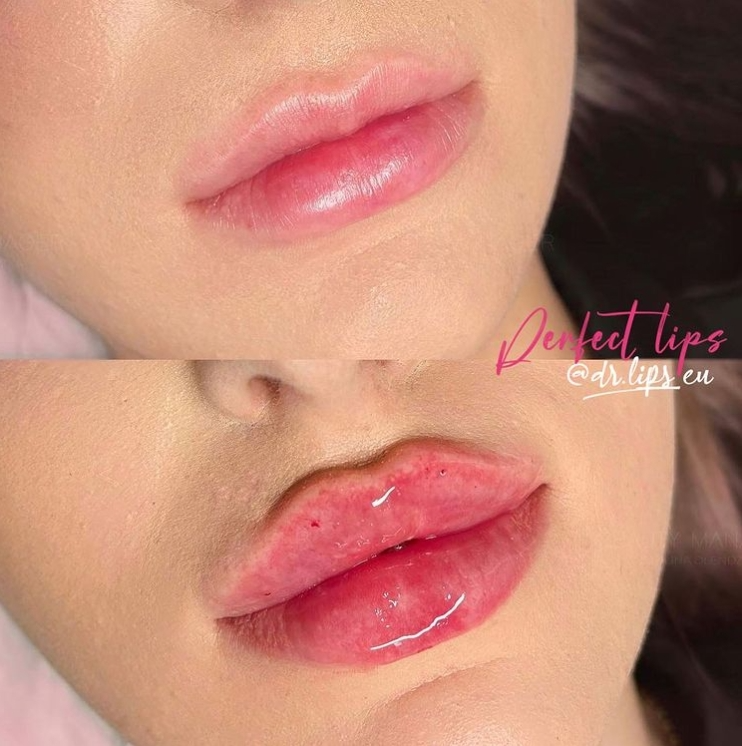 Fillerji za ustnice Primorska