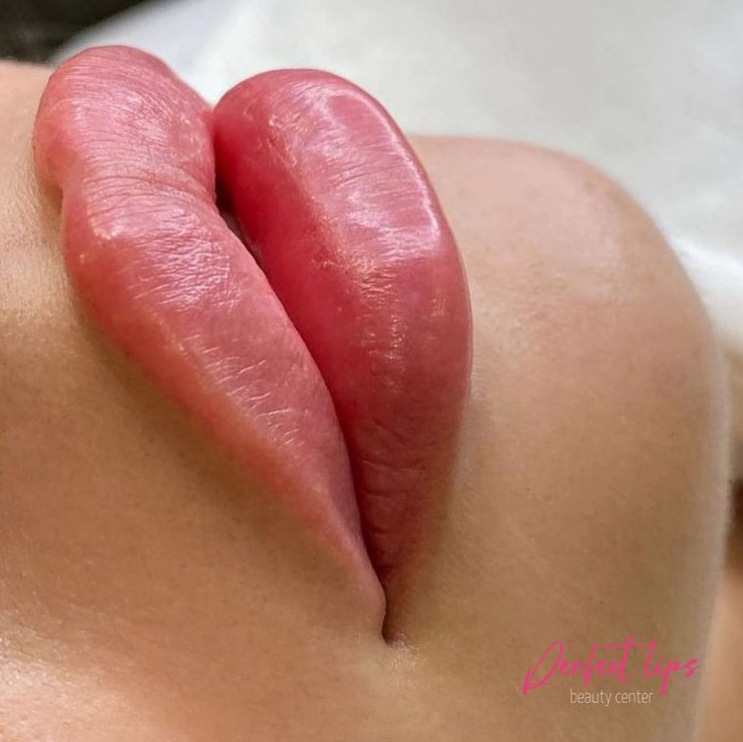 Povečanje ustnic s fillerji Primorska