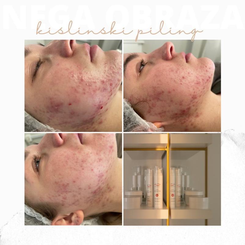 Profesionalna nega obraza Pomurje