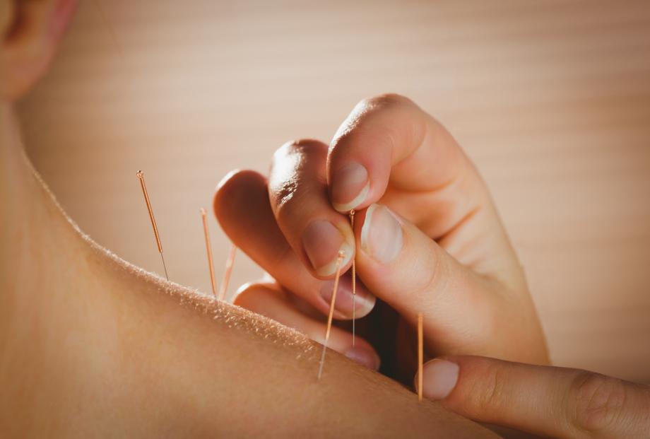 Vstavljanje akupunkturnih igel