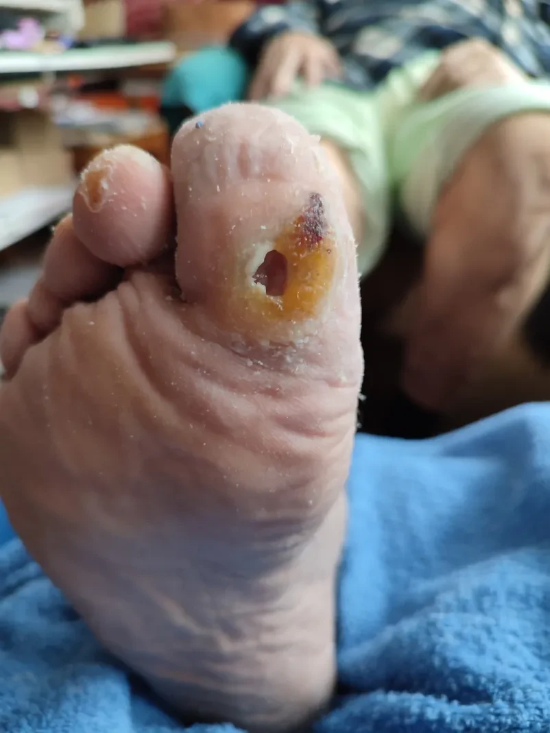 Medicinska pedikura na domu Maribor