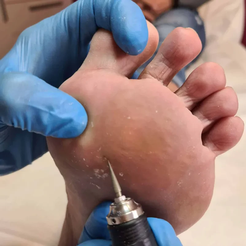 Tečaji medicinske pedikure