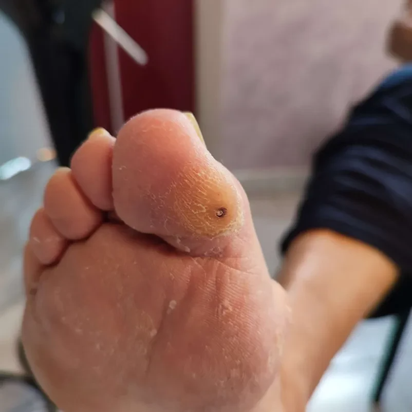 Izobraževanje za medicinsko pedikuro