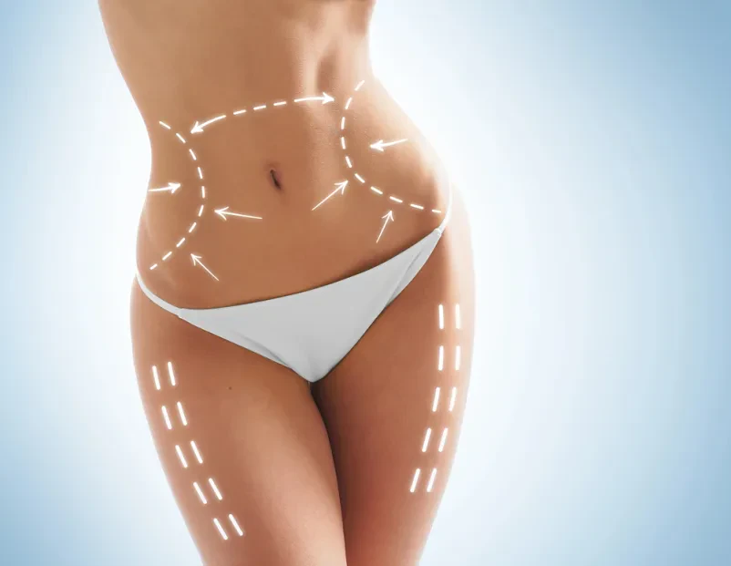 Kvalitetna liposukcija Domžale