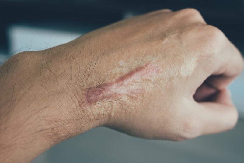 Lasersko zdravljenje nepravilnosti na koži