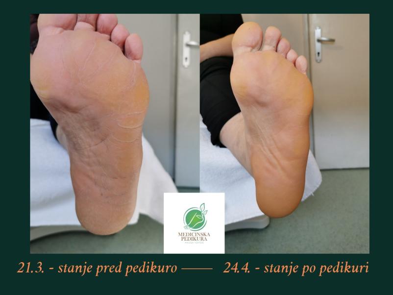 Medicinska pedikura na domu