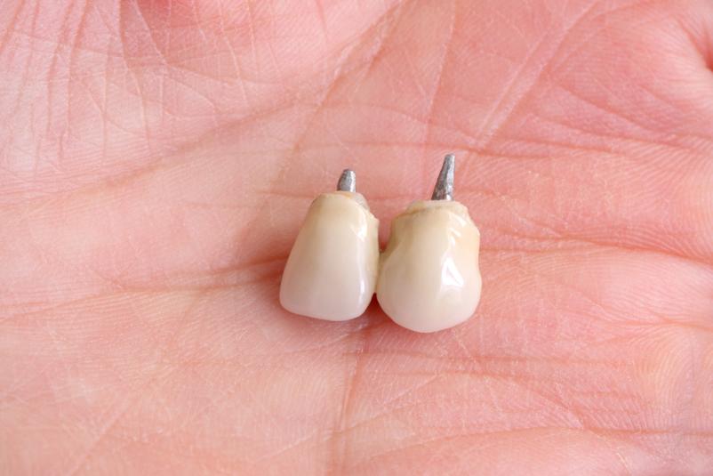 Implantologija in ortodontija Ljubljana