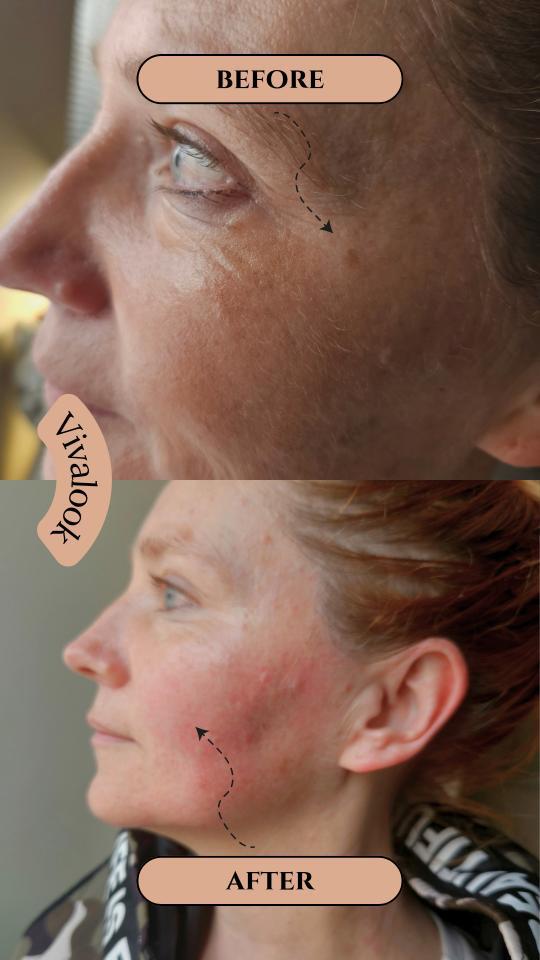 Maderoterapija obraza – Naravna pomladitev in sprostitev