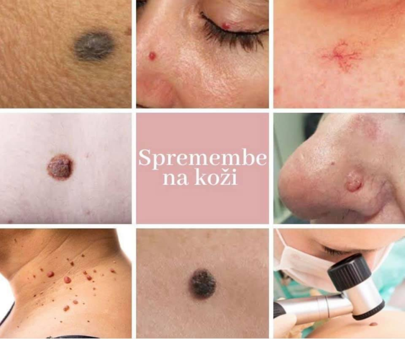 Različna kožna znamenja