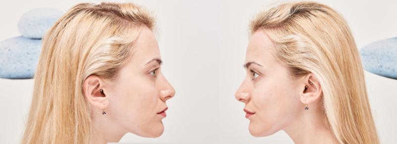 Samoplačniški dermatolog za pigmentna znamenja