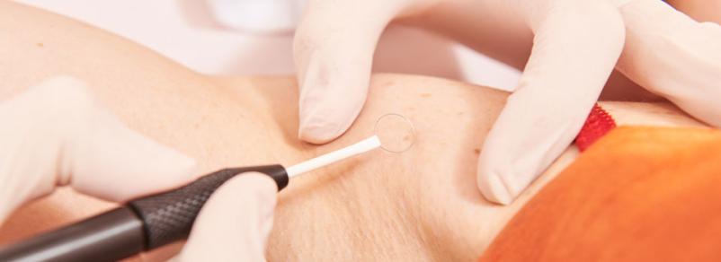 Dermatološki pregled pigmentnih znamenj Nova Gorica