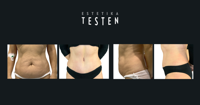 Visoko kvalitetna estetska kirurgija Slovenija