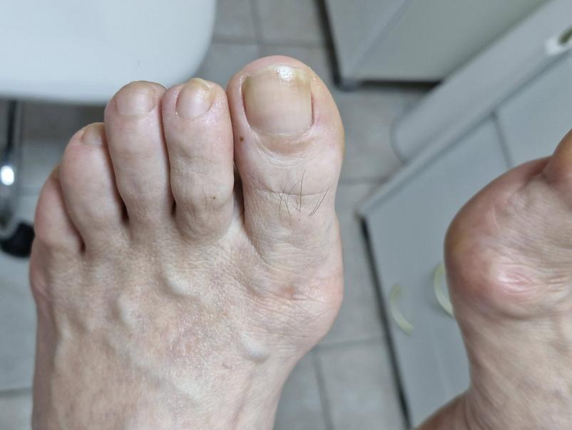 Medicinska pedikura Maribor