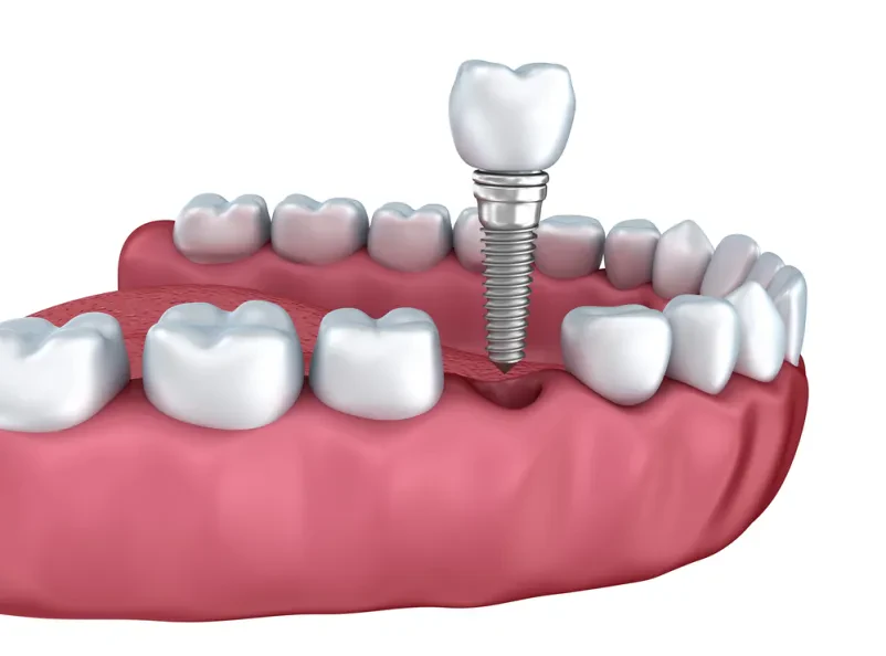 Ugodni zobni implantati Maribor