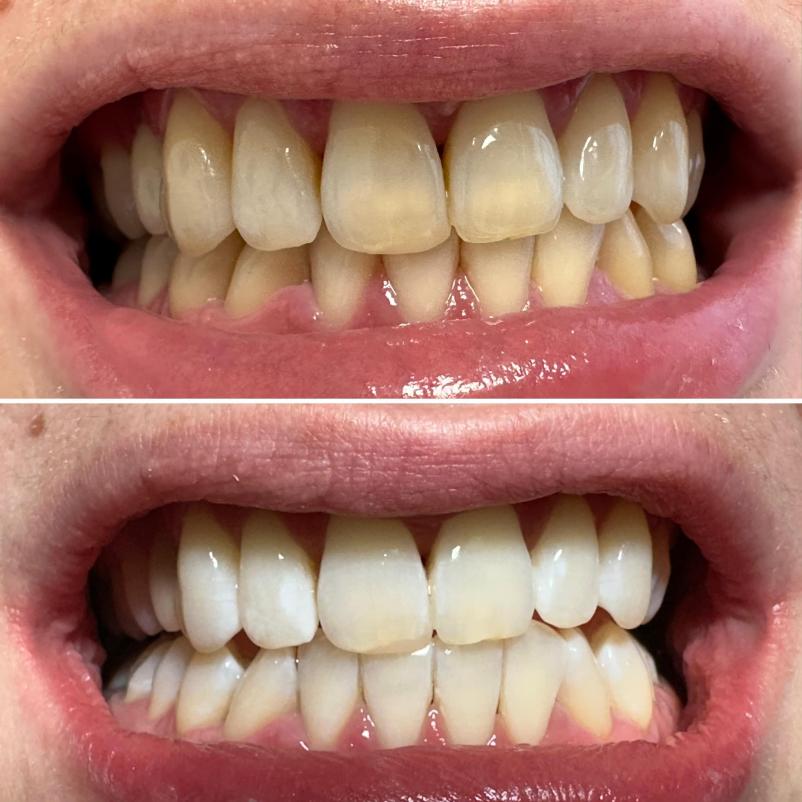 Profesionalno beljenje zob Maribor