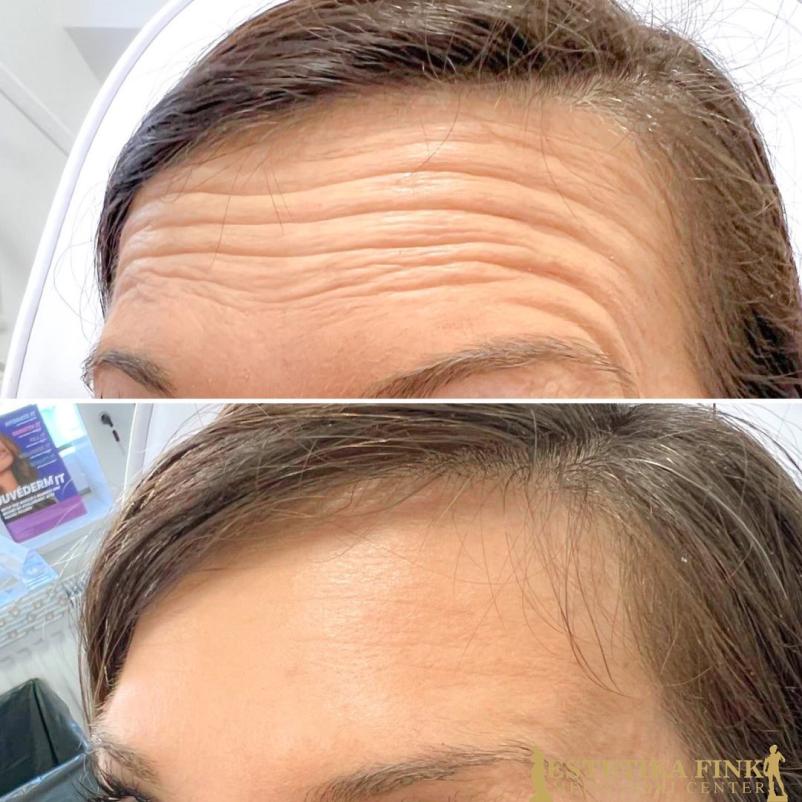 Pomlajevanje z botoksom Ljubljana, Trzin, Osrednja Slovenija