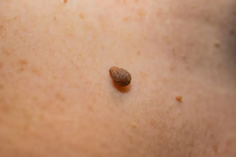 Odstranjevanje fibromov Hrastnik, Posavje