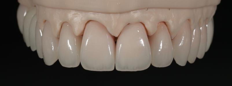 Izdelava zobnih protez in mostičkov