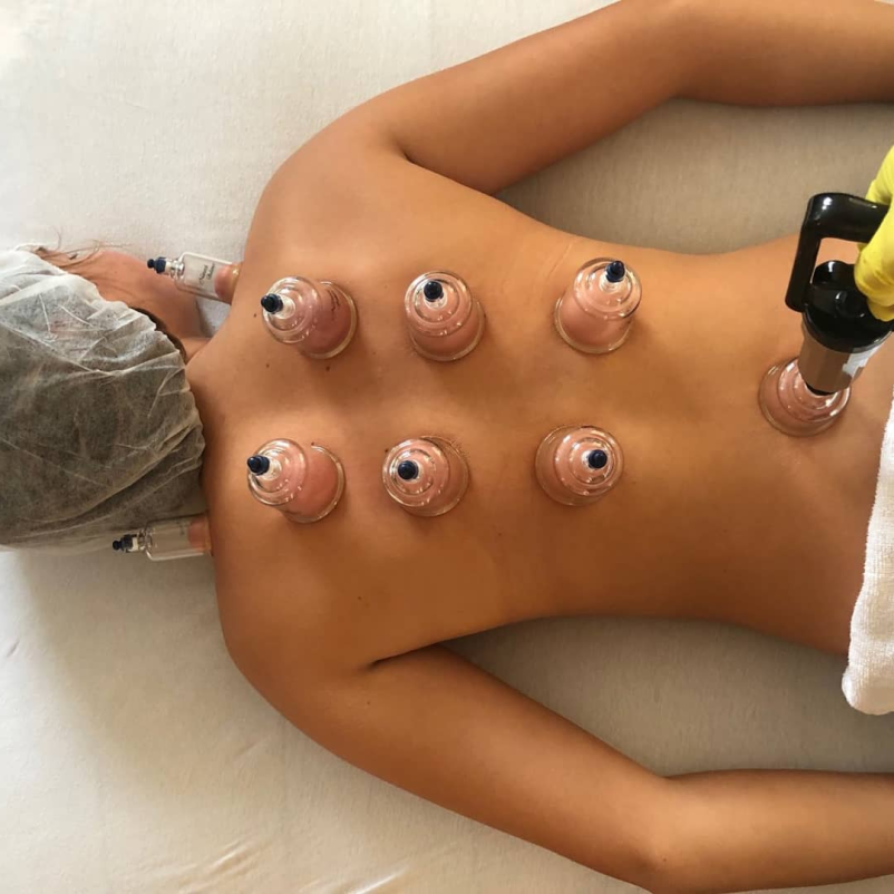 Terapija z ventuzami Domžale