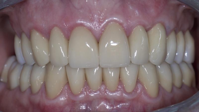 Fiksna, snemna zobna protetika in implantologija Osrednja Slovenija