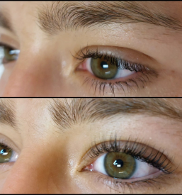 Keratinsko vihanje trepalnic BTC