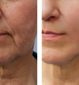 Microneedling proti staranju Koroška