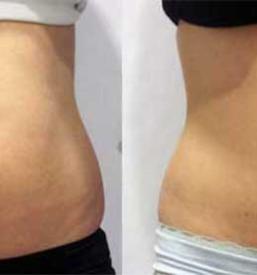 Preoblikovanje telesa Ljubljana