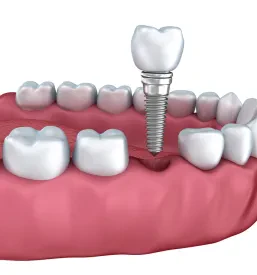 inmplantant