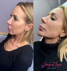 Povečanje ustnic s hialuronsko kislino Primorska