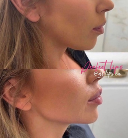 Povečanje ustnic s fillerji Primorska