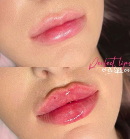 Polnjenje ustnic s hialuronsko kislino Primorska